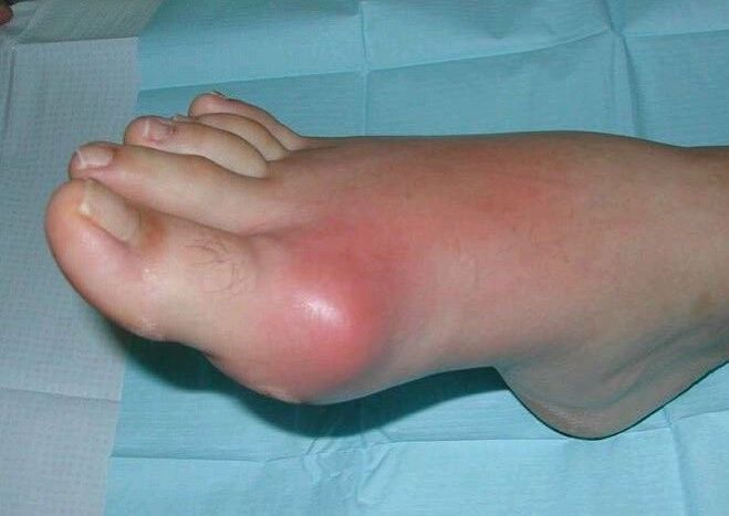 Clinical picture of arthritis of the foot - swelling and inflammation