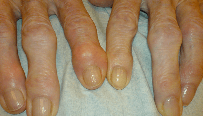 pain in the joints of the fingers in osteoarthritis