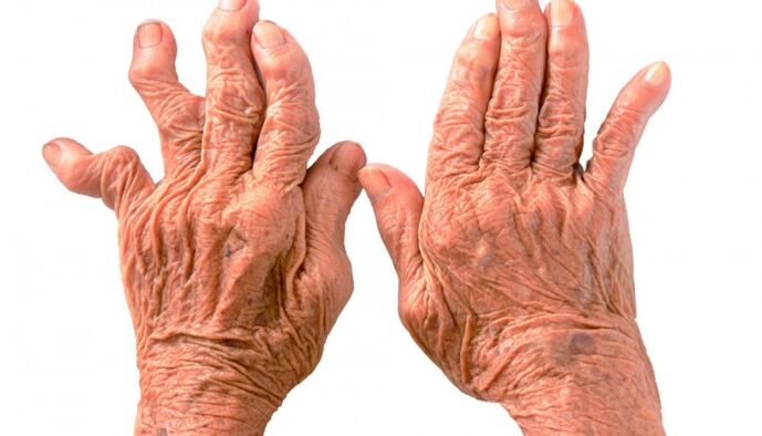 rheumatoid arthritis as a cause of joint pain in the fingers