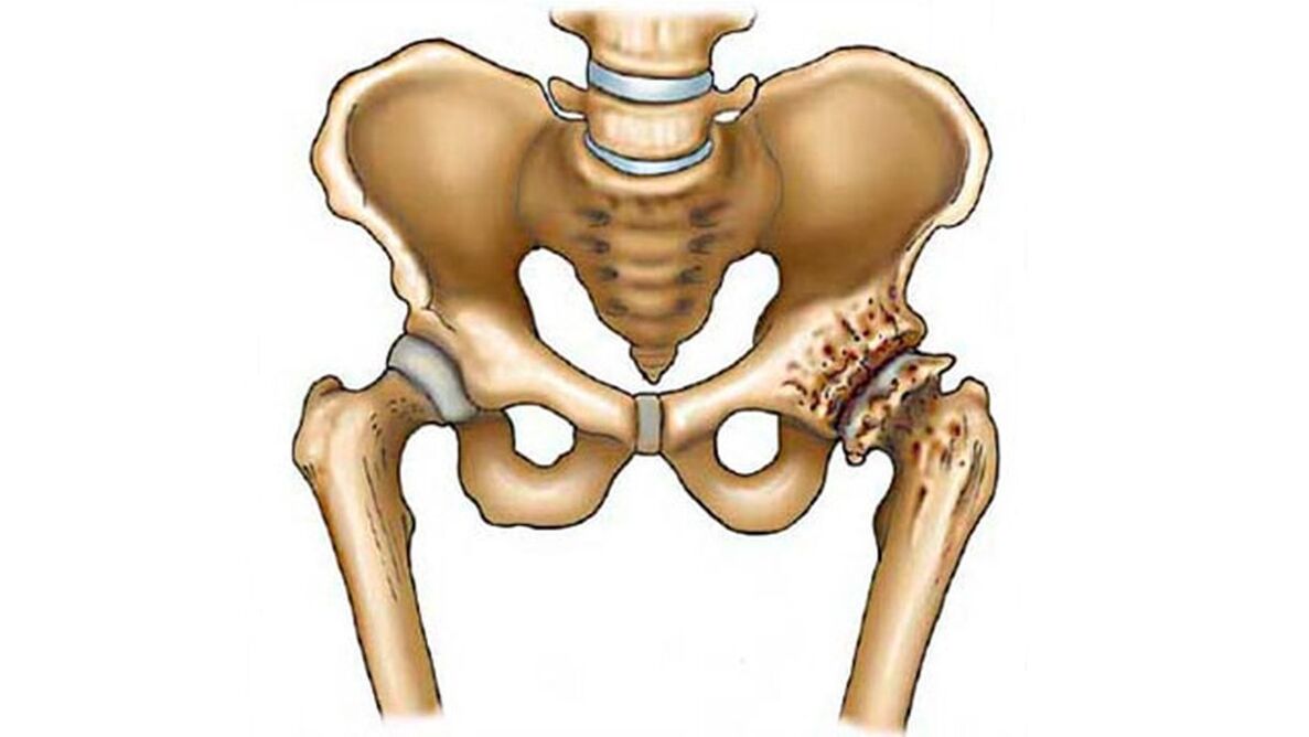 damage to the hip joint in the presence of arthrosis