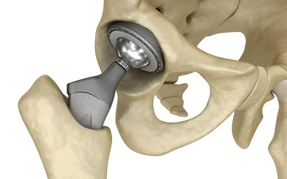 hip prosthesis