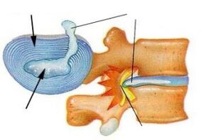 destruction of the fibrous ring in cervical osteochondrosis