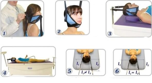 treatment of cervical osteochondrosis with traction