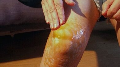 Fruits to treat arthrosis of the knee joint
