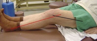 The progressive arthrosis of the knee joint