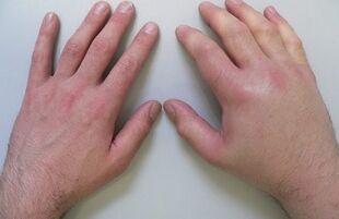 joint pain in the joints of the fingers