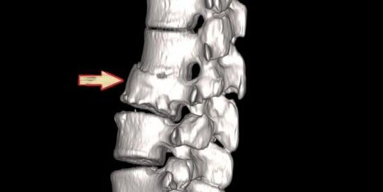 spinal pathology as the cause of back pain
