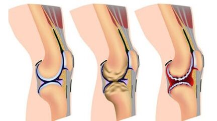 The severity of the disease at three degrees