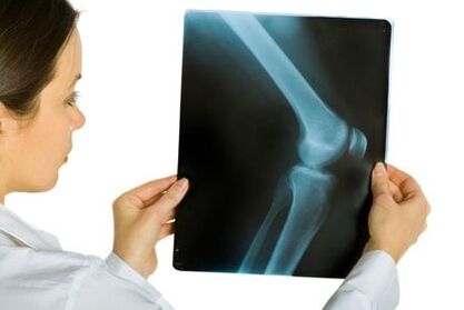 Treatment of the joint joint of the knee joint