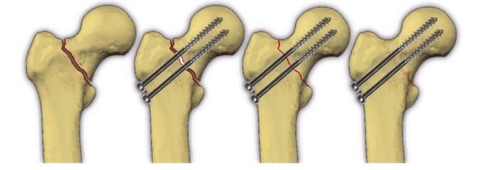fixing the bone body with pins in case of hip pain