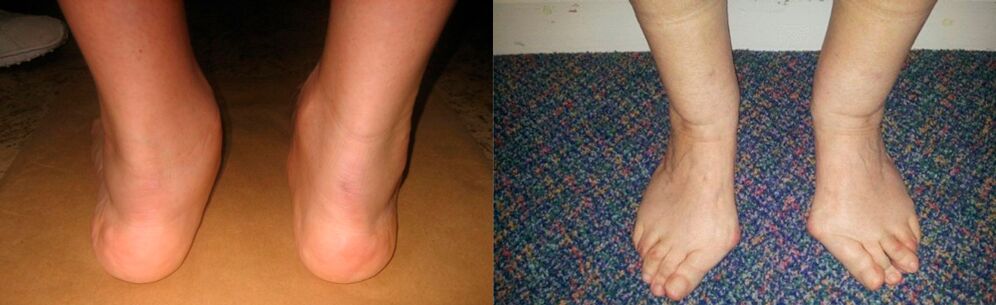 Arthrosis of the big toe and deforming arthrosis of the ankle