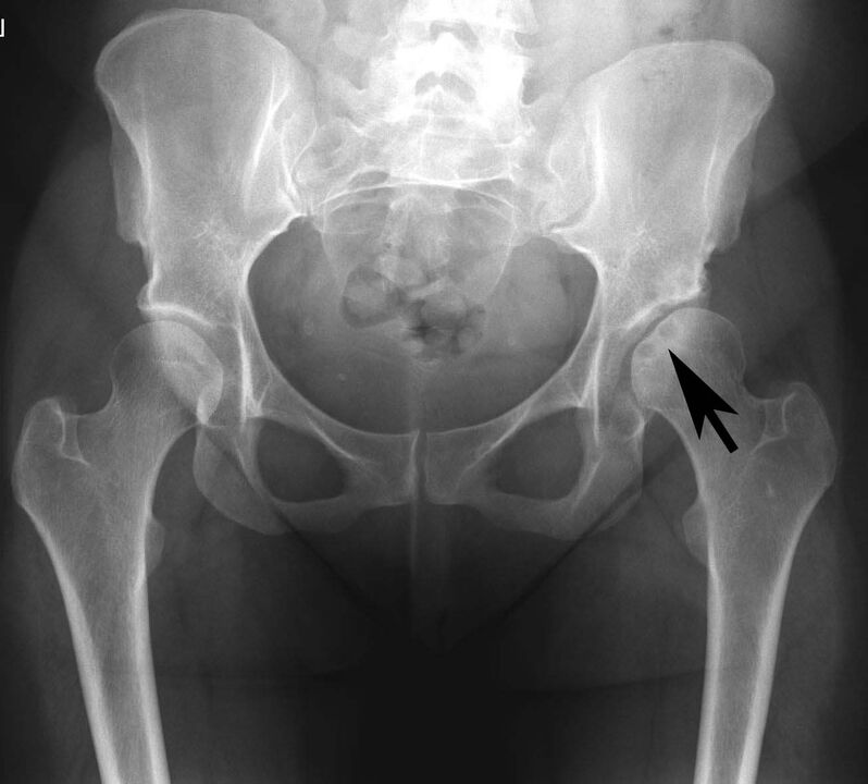 Deposition of calcium salts in the hip joint by pseudogout on X-ray