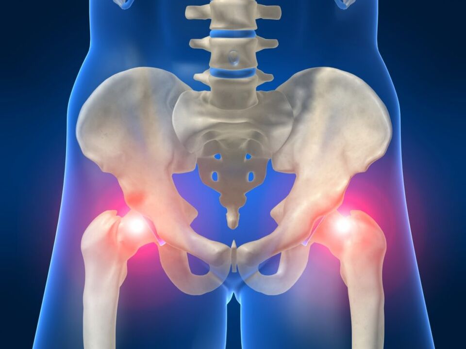 In ankylosing spondylitis, bilateral hip pain is disturbing